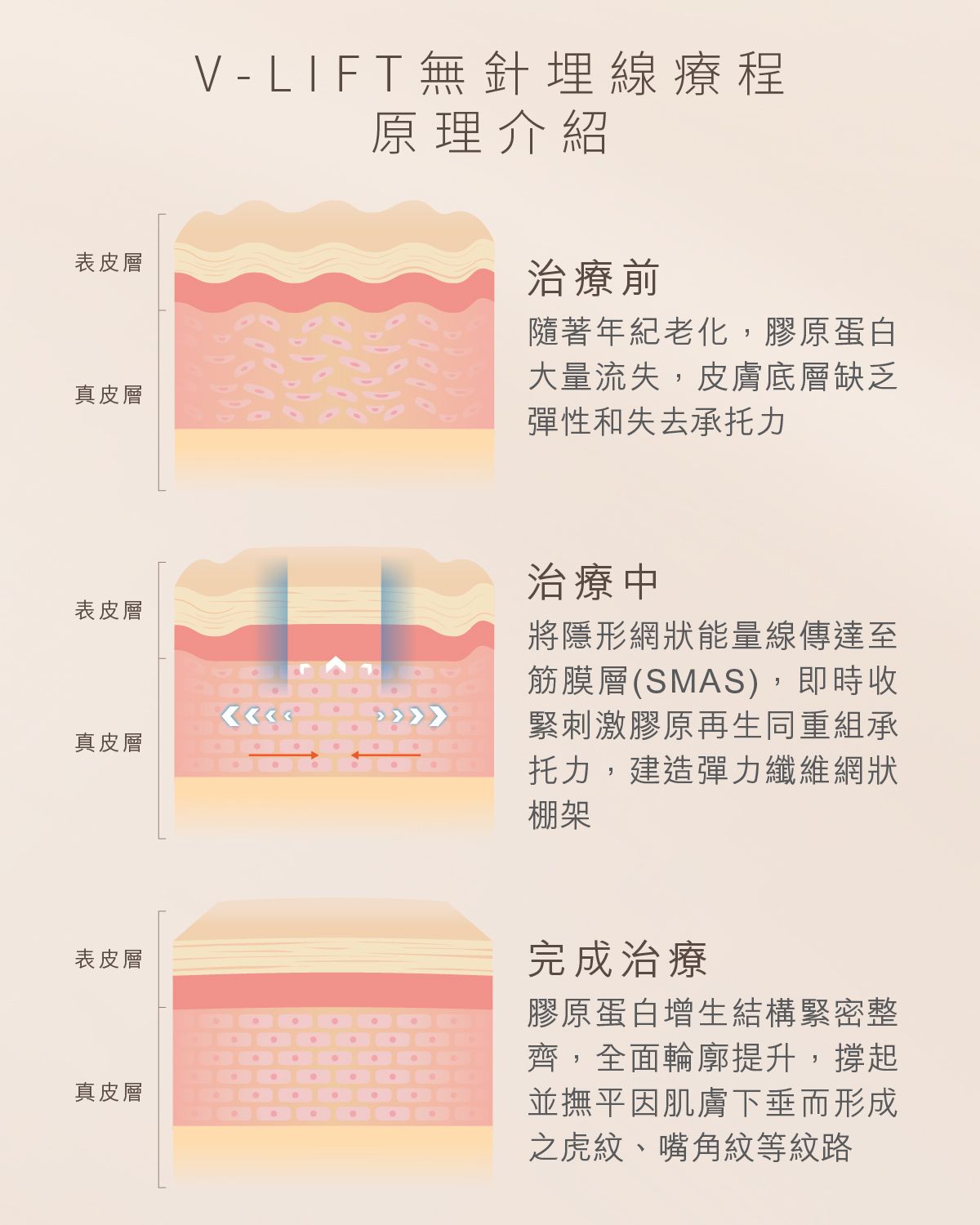 近乎零痛感解決衰老肌膚鬆弛、下垂、幼紋等問題 緊緻肌膚、V面、提升面部輪廓同時持續改善皮膚質素
